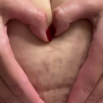 Ashley Graham shows postpartum stretch marks on social media