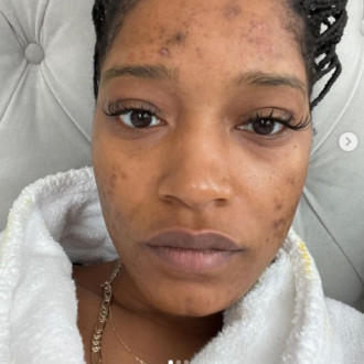 Keke Palmer will block anyone trying to tell her how to manage her acne