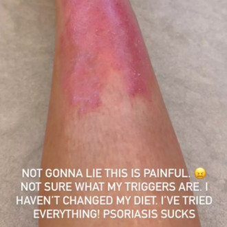 Kim Kardashian shares 'painful' update on her psoriasis battle: 'I've tried everything!'