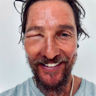 Matthew McConaughey’s face horrifically swollen by bee sting