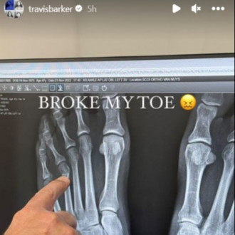 Travis Barker breaks toe